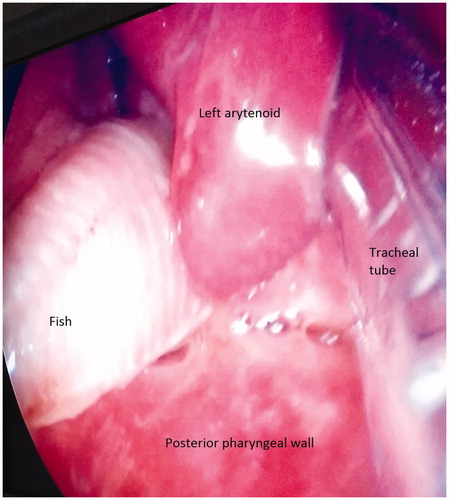 Figure 2. Direct laryngoscopy shows a fin-like structure lateral of the left arytenoid with supraglottic oedema. Intubation with a single-lumen tube.