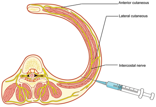 Figure 1 Thoracoscopic intercostal nerve block (TINB) schematic diagram. TINB was administered by infiltration of intercostal nerves by cocktail analgesics from the space between parietal pleura and intercostal muscle.