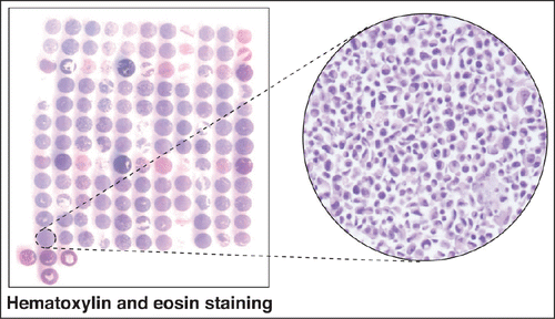 Figure 1. Hematoxylin and eosin staining of breast cancer CMAs. The panel on the left is the hematoxylin and eosin staining of a CMA slide. The panel on the right is a magnified view (20×) of the CAMA1 cell pellet on the CMA showing individual cells in greater detail.