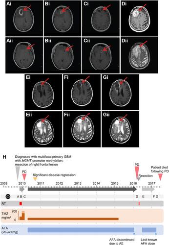 Figure 3 Radiological Disease Assessment in Patient 3. (A) October 11, 2009: Preoperative assessment. (B) October 16, 2009: Postoperative assessment. Following resection of right frontal lesion, the patient began first-line treatment with RT (60 Gy in 30 fractions over 6 weeks) with TMZ (75 mg/m2 QD) for 6 weeks, followed by adjuvant TMZ (150–200 mg/m2; Days 1–5 of each 28-day cycle). (C) February 2010: the patient experienced disease progression in February 2010 after three cycles of adjuvant TMZ. In April 2010, the patient enrolled in trial 1200.36 and began afatinib (20–40 mg QD), plus TMZ (50 mg/m2 QD for 21 days of every 28-day cycle). Significant disease regression was observed after 5 cycles and maintained for approximately 5.5 years. TMZ was discontinued in March 2015. Afatinib was discontinued in January 2016 due to skin toxicity. (D) March 2016: the patient experienced disease progression, and underwent surgical resection in April 2016, followed by adjuvant RT. Afatinib monotherapy (30 mg QD) resumed in June 2016. (E) July 2016, and (F) February 2017: the patient showed controlled disease, with radionecrosis in the opinion of the treating physician. Last known afatinib dose was received in March 2017. (G) April 2017: final assessment. Progression was observed involving the right frontal lobe. The patient died in June 2017. (A–C) i and ii: scans at different positions. (D–G) i and ii: T1-weighted, gadolinium enhanced and T2-weighted scans, respectively, at the same position. H Timeline of treatment and response. Horizontal gray arrows represent time on treatment before disease progression. Red arrows indicate lesion location. The dates of the scans shown in panels (A–G) are illustrated on the light gray horizontal bar (with black, circular scan icon).