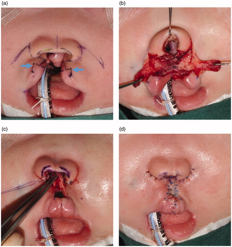 Figure 3. Cheiloplasty performed after 18 months of PNAM. (a and b) Columellar reconstruction was performed with local flaps. Arrow: small white lip portions with lateral vermillion. (c and d) A skin graft was applied on the philtrum.