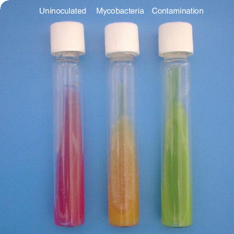 Figure 3. TK Medium® rapid culture system for tuberculosis.Mycobacterial growth changes the color of the medium from red to yellow. Common contaminants, such as fungi or Gram-negative bacteria, change the color from red to green. Image courtesy of Salubris, Inc. (MA, USA) and reproduced with permission.