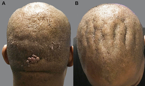 Figure 4 CVG and widespread AKN papular lesions: patient 3 with CVG onset within two years of AKN starting in the nuchal area: posterior (A) and top (B) views of the head, showing AKN in the vertex, mid and frontal zones with notable involvement of the recesses of CVG folds located in the middle to the frontal scalp.