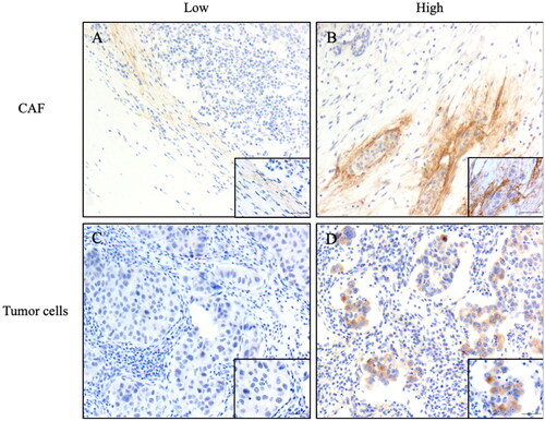 Figure 7. Representative images of immunohistochemistry staining IDC-NOS patients tissues showing the expression of TNC. (A) TNC low expression in the CAF; (B) TNC high expression in the CAF; (C) TNC low expression in the tumor cells; (D) TNC high expression in the tumor cells. Magnification ×100, and ×400; the solid black line indicates the scale bar, 100 μm.