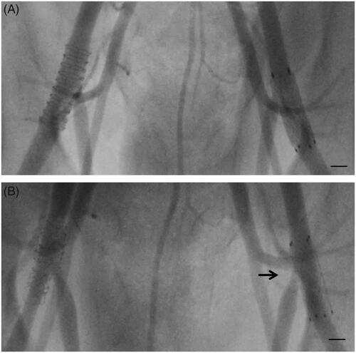 Figure 3. Post-interventional angiography displaying the acute implantation result of a Nitinol stent (left femoral artery, right side of X-ray image) and zinc stent featuring ultrathin center struts (right femoral artery, left side of X-ray image) (A) and at the 12-week follow up investigation (B). The arrow indicates the side branch jailing of the Nitinol stent (B) after 12 weeks. The marker represents 5 mm.