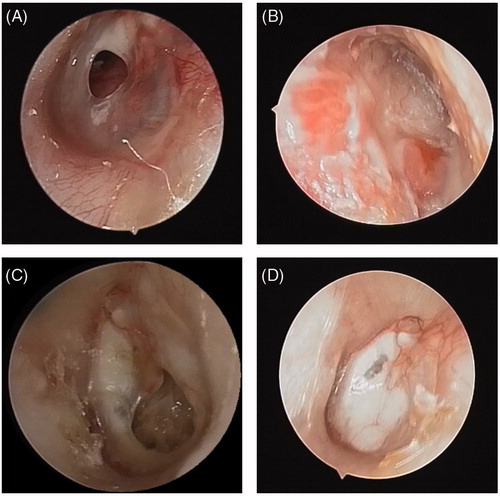 Figure 1. Changes of tympanic membrane before and after operation. (A,B) Pre- and post-operative otoendoscopic images of AlloDerm group. (C,D) Pre- and post-operative otoendoscopic images of cartilage perichondrium group. At 6 months after the operation, the tympanic membrane healed completely, without otorrhea, tympanic membrane sclerosis or other complications.