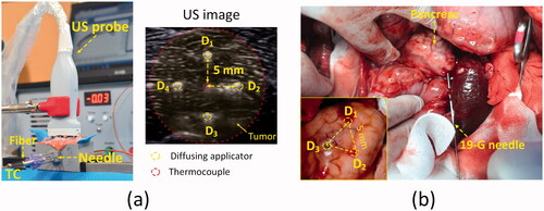 Figure 2. Experimental set-up for multiple circumferential interstitial laser ablations (CILAs) of porcine pancreatic tissue: (a) illustration of CILA in ex vivo pancreatic tissue with four sequential insertions of diffusing applicator under ultrasound (US) guidance and (b) three CILAs in in vivo pancreatic tissue after laparotomy (TC: thermocouple, D1∼D4: inserting positions of diffusing applicator).