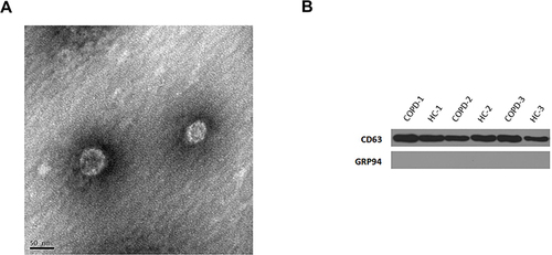Figure 1 Detection of exosomes. (A) Western blot analysis detected the exosomal marker, CD63. (B) Representative TME image of an exosome. The structure of the exosome is cystic with a double membrane and a diameter of about 50 nm.