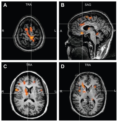 Figure 2 Demonstrates the activated regions of the patients during the SLR maneuver. There is activation in the leg sensory motor region S1 (A), anterior cingulate gyrus (B), thalamus and caudate (C), and insular regions (D).