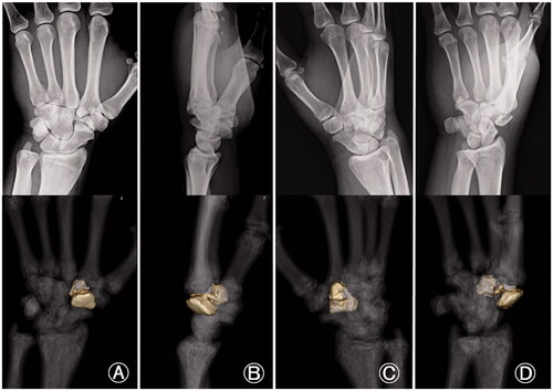 Figure 7. Comparison between X-ray and three-dimensional computed tomography (3 D CT) images of an isolated coronal shearing fracture of the left trapezoid. (A) X-ray in anteroposterior view and the corresponding 3 D CT; (B) X-ray in lateral view and corresponding 3 D CT; (C) X-ray in oblique view in pronation and corresponding 3 D CT; (D) X-ray in oblique view in supination and corresponding 3 D CT. The lateral and the oblique views in supination are important to identify a coronal shearing trapezoid fracture. In particular, the oblique view in supination clearly depicts a coronal shearing trapezoid fracture. No useful information could be obtained from the anteroposterior and oblique views in pronation.