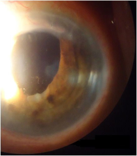 Figure 2 Anterior chamber lens details (LEFT EYE).