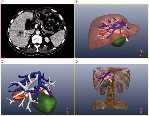 Figure 2. 2D CT image and the relevant 3D images. (A) Original CT image of the patient, (B) surface-rendering of the tumour (orange), the liver (brown), bile ducts and gallbladder (green), and the important pipeline structures (HA, red; HV, blue; PV, white), (C) surface-rendering of the tumour and the important pipeline structures, (D) 3D model scene.