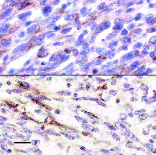 Figure 3.  Upper: vimentin immunolabelling in the majority of the neoplastic cells. Lower: myoglobin immunoreactivity in scattered neoplastic cells. Avidin–biotin complex method, Mayer's haematoxylin counterstain. Bar = 10 µm.