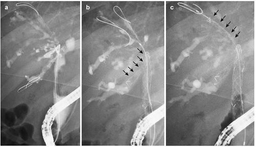 Figure 2. A case of MHBO with primary sclerosing cholangitis. (a) Bismuth IIIa MHBO was observed by ERCP. (b) A 10 mm × 10 cm large-cell Niti-S slim-delivery stent was placed in B6. (c) After the other guidewire was placed in B5, the new slim-delivery USEMS was placed along the guidewire. MHBO: malignant hilar biliary obstruction; ERCP: endoscopic retrograde cholangiopancreatography; USEMS: uncovered self-expandable metallic stent.