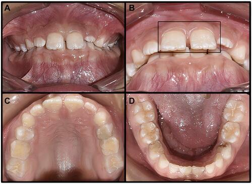 Figure 2 Dental photography. (A) Cross-bite. (B) The square in the medial incisors show enamel hypomineralization affecting both dentitions (C) superior maxillary (D) inferior maxillary, vertical overbite.