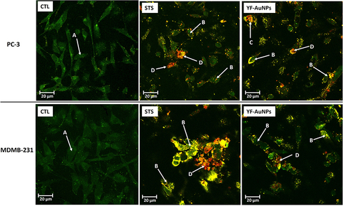 Figure 15 Confocal microscopy images of apoptosis and necrosis of PC-3 and MDAMB 231 cells with no treatment (CTL) and after treatment with staurosporine (STS) and YF-AuNPs. (A) Healthy cells, (B) early apoptosis, (C) late-apoptosis, and (D) necrotic cells.