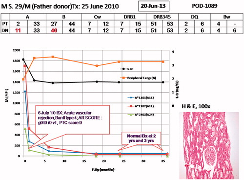 Figure 2. Graph showing the complete status of patient; on top is his age, initials, mentioning father as donor, and transplant date. On top in box is the date when this graph was prepared and right side mentions days since induction of protocol. HLA match status of patient (PT) and donor (DN) are mentioned. On the X-axis is the follow-up in months since the patient was inducted in the protocol, on Y-axis left is antibody measurement by Luminexx assay (in mean fluorescent intensity – MFI) and on right side is serum creatinine (SCr; mg/dL) and peripheral T-regulatory cells (CD127low/−CD25highCD4+) in percentage. The different colored spikes are for antibodies shown by asterix in right side, black line is for SCr and yellow line for p-Tregs. On the graph are highlighted biopsy dates and findings. This figure shows that SCr and p-Tergs have remained fairly stable. On right corner is photomicrograph showing renal allograft biopsy performed at 3 years post-transplant showing normal glomerulus, part of a medium calibre artery and surrounding tubules and 1 artery, Hematoxylin and Eosin, 100×.