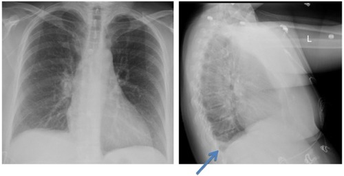 Figure 2 Chest X-rays.
