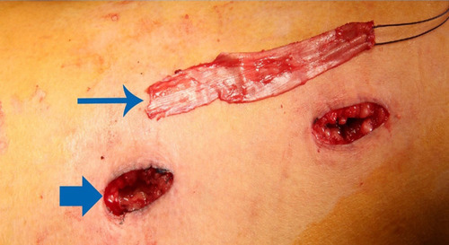 Figure 6 Image of two 2-cm horizontal incisions (over the iliotibial band and 6 cm above the patella) with the fascia lata strip.