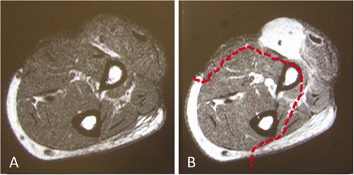 Figure 1. Images prior to reoperation. (A) MRI T1 weighted image. (B) MRI T1 weighted image with gadolinium enhancement. The dotted line indicates the extent of tumor resection. MRI: Magnetic resonance imaging.