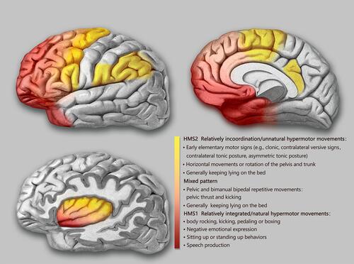 Figure 2 Schematic representation of the seizure semiology patterns of SHE derived from anatomical-electrical-clinical data.