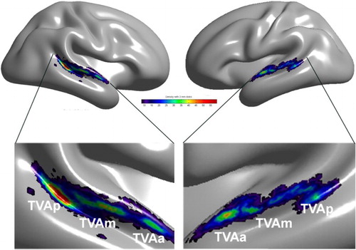 Figure 1. Temporal Voice Areas (TVAs) in the human brain. A cluster analysis of the density map of voice > nonvoice contrast revealing three main clusters of voice sensitivity in each hemisphere along a voice-sensitive zone of cortex extending from posterior STS to mid-STS/STG to anterior STG. The cluster with the greatest peak density is in right pSTS, consistent with individual images. Reproduced (permission pending) from Pernet et al. (Citation2015).