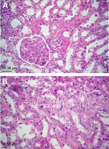 Figure 3 Kidneys of hamsters of the injected group.Notes: (A) Kidney of a hamster of the injected group showing marked vacuolar degeneration and necrosis of tubular epithelium together with an increased mesangial matrix and hyalinization of glomerular tuft and tubular basement membrane (hematoxylin and eosin stain [H&E], magnification, ×40). (B) Kidney of a hamster of the injected group showing focal interstitial mononuclear cell infiltration (H&E, ×40).