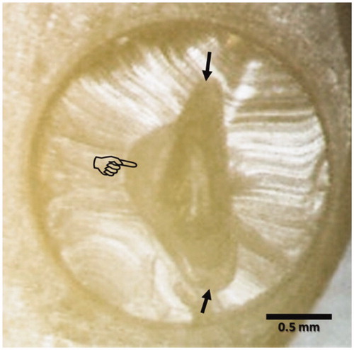 Figure 3. Typical MSBS mixed failure mode under stereomicroscope. The composite resin cylinder separation from the dentin has resulted in exposure of dentin surface (finger pointer) and partial fracture of the adhesive layer (arrows).