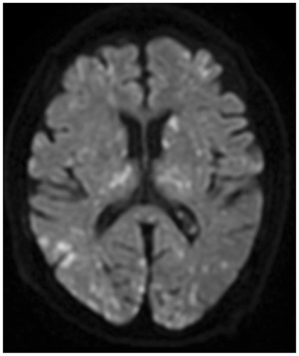 Figure 2 Brain magnetic resonance imaging. Diffusion-weighted imaging showing disseminated, hyperintense dot-like lesions in the brain, demonstrating the “starfield” pattern.