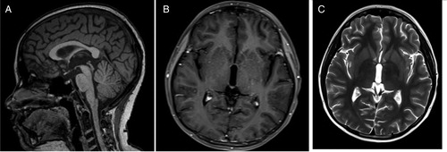 Figure 3. Post-treatment magnetic resonance imaging with coronal (A) and sagittal T2 (B) with contrast (C) showing intensely enhancing lesion in the right midbrain.