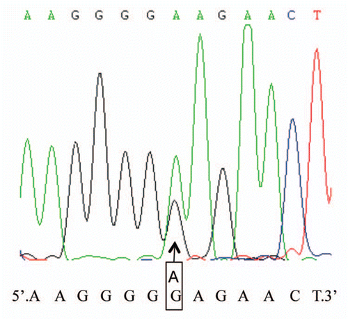 Figure 1 Graphic presentation of the sequencing analysis of PRNP. The presence of mutation is confirmed by direct sequencing of PRNP after PCR amplification. It shows a G to A heterozygous transition at codon 196 in one PRNP allele, leading to an exchange from Glu (E) to Lys (K). The arrow above the curves indicates the position where both G and A are present. The sequences of nucleotides and the encoding amino acids are illustrated at the bottom of graph.