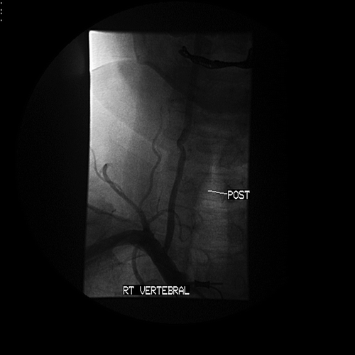 Figure 3 Vertebral angiogram immediately after stenting of the ostial lesion and retrieval of the FilterWire showing the final angiographic result.