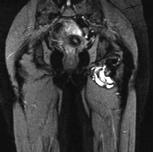Figure 3b. Sagittal T2-weighted, fat-suppressed contrastenhanced MRI demonstrating high signal intensity at the periphery of the mass and intermediate signal intensity centrally. There is a clear demarcation between mass and the surrounding soft tissues.