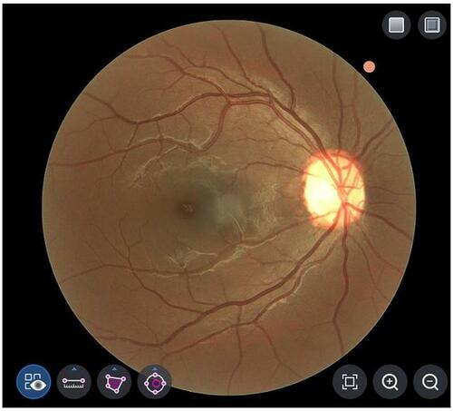 Figure 1 Color 45° fundus photograph of an eye taken with optical coherence tomography (HOCT-1F) without pupil dilation.