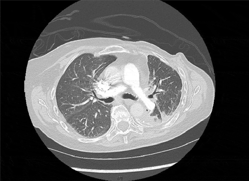 Figure 2. Resolution of pneumonitis