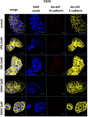 Figure 6 Confocal imaging of E-cadherin and N-cadherin expression in T47D cells cultured alone (control) or in the presence of VPA (2 mM, 5 mM) and SAHA (2 µM, 5 µM).Notes: Fixed cells were blocked and incubated with an anti-E-cadherin and anti-N-cadherin antibodies, followed by the respective secondary antibodies conjugated with Alexa fluorochromes as described in Material and methods. Nuclei were stained with DAPI. 100x oil immersion objective was used. Representative images are shown.Abbreviations: SAHA, vorinostat; VPA, valproic acid.