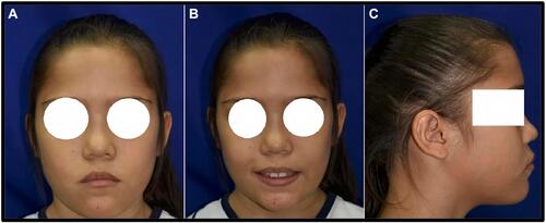 Figure 1 Dysmorphic phenotype in patient with DS. (A) Frontal view. (B) Smile in a frontal view. (C) Lateral view.