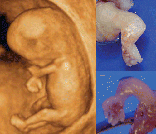Figure 43.  Upper limb abnormality at 11 weeks of gestation. 3D ultrasound revealed contracted elbow joint abnormality. Right figures show macroscopic appearance of upper limbs of aborted fetus.