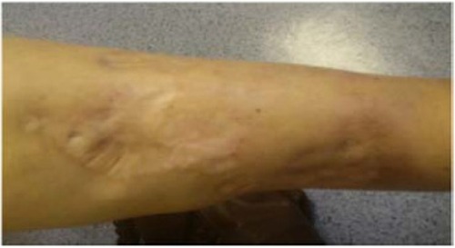 Figure 3 Skin manifestation of calciphylaxis. Left distal leg taken 4 months after the initiation of continuous ambulatory peritoneal dialysis.