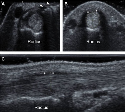 Figure 2 Ultrasound findings after methotrexate injection.