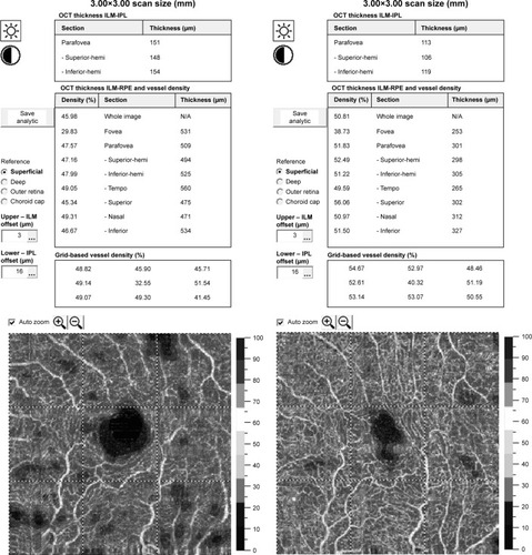 Figure 2 The fovea vessel density (FVDS) measured in superficial capillary plexus (SCP) using a density function on the imaging software.