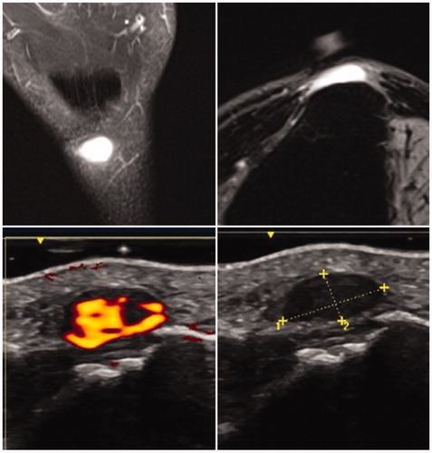 Figure 2. Top images from pre-operative MRI. T1 fat saturated in coronal and axial planes. Bottom images from pre-operative doppler ultrasound.