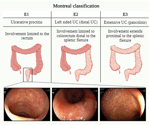 Figure 1. The Montreal classification of ulcerative colitis.