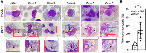 Figure 2 Wright-Giemsa staining images of whole blood (WB) cells with DENV 24 h post-incubation. Following DENV (MOI = 1) co-culture in 100 μL of WB ex vivo for 24 h, Wright-Giemsa staining, shown by an oil immersion field (100 × objectives), presented thrombophagocytosis (A), and the percentages of thrombophagocytosis are shown (B). MOCK is the control group treated without DENV. The quantitative data are depicted as the mean ± SD obtained from six cases (N = 6) and the representative image was selected from three microscopic observations in the fields. ** p < 0.01.