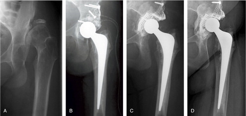 Figure 1.  A 43-year-old female with developmental dysplasia of the hips with high dislocation. A. Preoperatively. B. Directly postoperatively after primary THA with distalization and reconstruction of the cup to its anatomical center of rotation giving a neurological deficit. C. Postoperatively after cup revision 2 years later with cranialization of the cup. D. 12 years after cup revision.