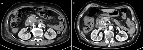 Figure 1 Enhanced computed tomography images of the abdomen. (A) Before treatment, there was a malignant tumor located in the head of the pancreas. (B) A malignant tumor has been detected in the pancreatic head of a patient who underwent gemcitabine plus nab-paclitaxel (GnP) chemotherapy along with immunotherapy.