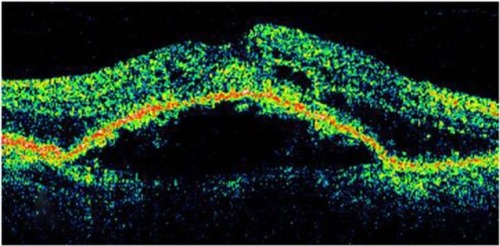 Figure 8 Stratus optical coherence tomography image.