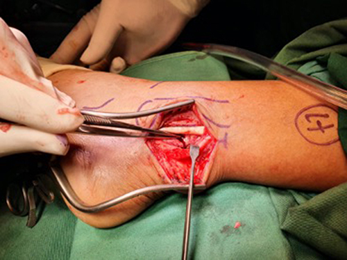 Figure 5 The peroneal tendon was exposed.