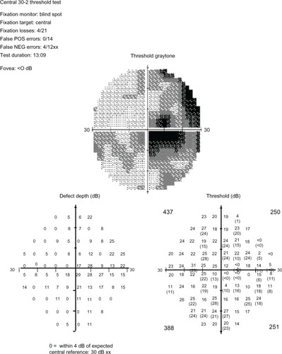 Figure 3 Stimulus V 30-2 Humphrey visual field demonstrates a cecocentral scotoma in the right eye.