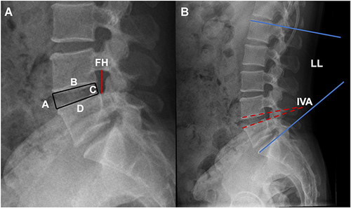 Figure 2 Radiographic measurement of IHI, FH, IVA and LL. (A) The intervertebral height index (IHI)= [(A + C)/ (B + D)] × 100, A, anterior disc height, C, posterior disc height, B superior disc depth, D inferior disc depth. (A) Foraminal height (FH) was measured by the distance between the inferior edge of the upper pedicle and superior border of the lower pedicle. (B) The intervertebral angle (IVA) was measured by the intersection angle between the inferior and superior endplate of the intervertebral disc; if the angular intersection located in the dorsal lumbar spine was marked as positive, then, the ventral part was marked as negative. (B) Lumbar lordosis (LL) was measured by the intersection angle between the superior endplate of S1 and the upper endplate tangent of L1.